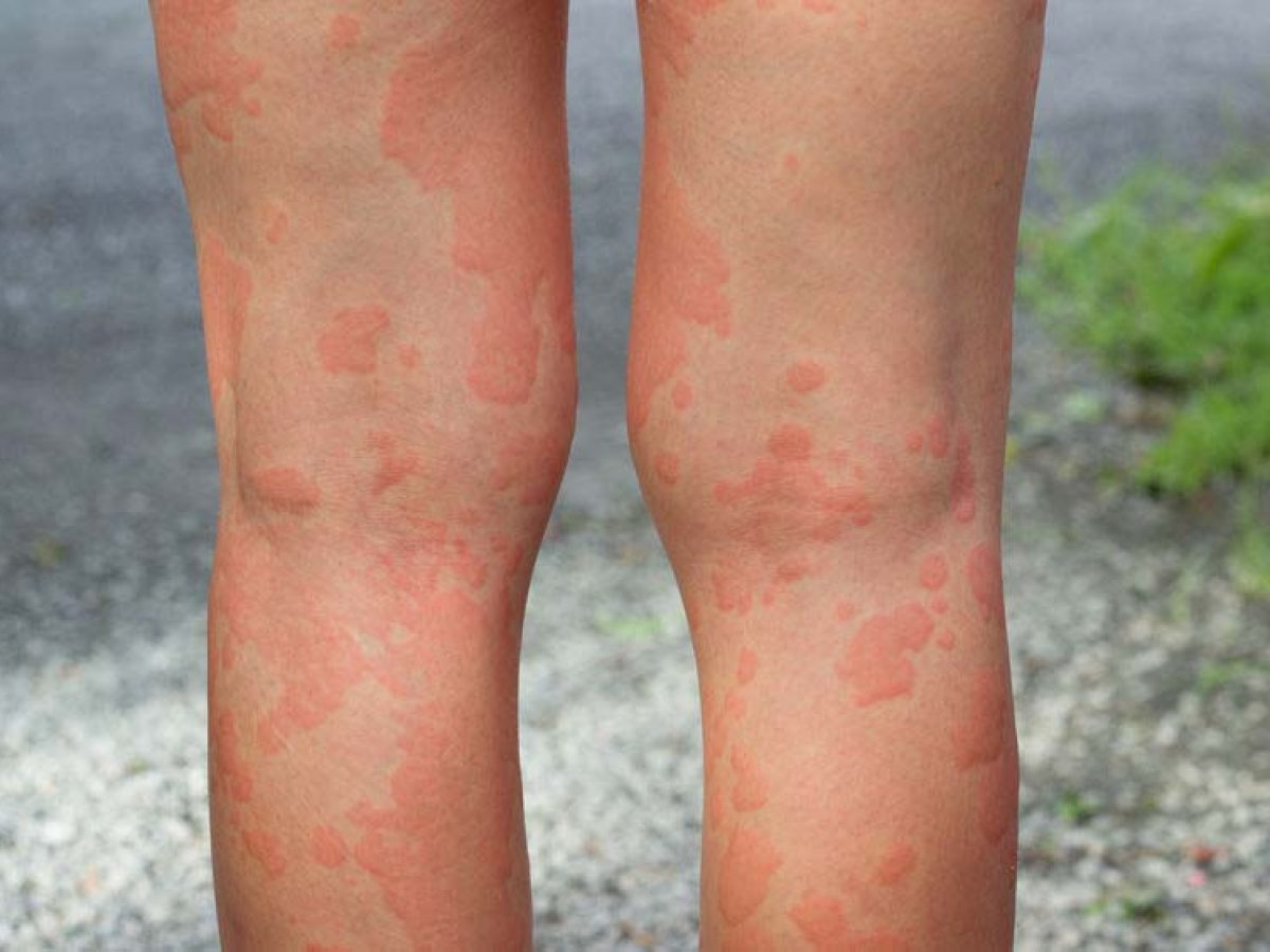 Alergias